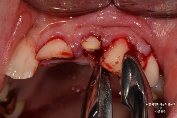 [치아외상] 부러진 앞니, 발치가 답인가요? (사고로 부러진 치아, 외과적정출술로 살리기) 관련 이미지 7