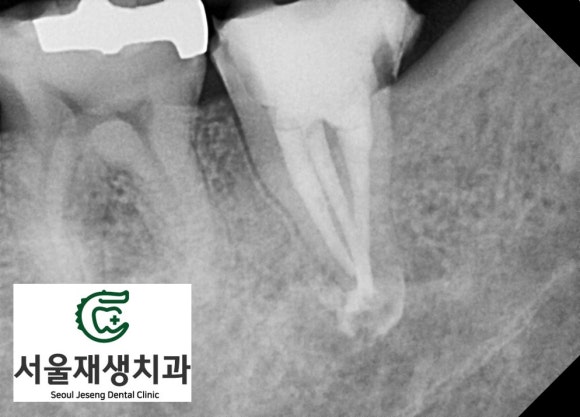 [재신경치료] 예전에 신경치료 받은 치아가 갑자기 너무 아파요! (서울재생치과, 현미경신경치료) 관련 이미지 7