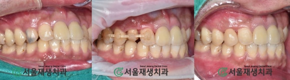 [치아정출술] 충치가 뿌리까지 진행되서 발치해야 한대요...뿌리 깊은 충치도 살려내기 (서울재생치과) 관련 이미지 13