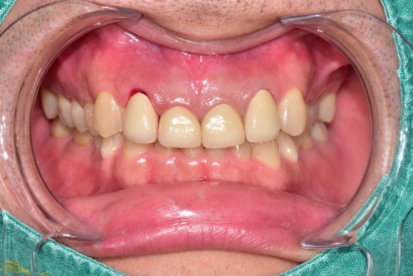 [치아살리기] 크라운 씌운 치아가 부러졌어요. 교정적정출술을 통해 내 치아 끝까지 써보기 관련 이미지 10
