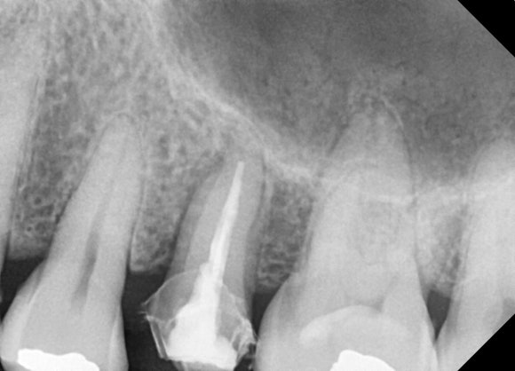 A Tooth Filled with Amalgam Long Ago Has Cracked. image 5