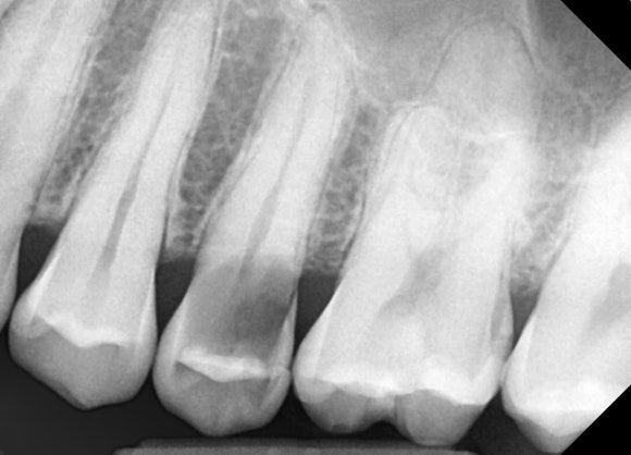 [치아살리기] 뿌리만 남은 치아의 치료 관련 이미지 4
