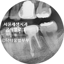 [재신경치료] 뿌리 끝 염증이 너무 심하대요...발치만이 답인가요? (폭발적인 반응에 부랴부랴 들고 온 두 번째 증례) 관련 이미지 17