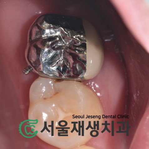 [재신경치료] 엑스레이를 찍었더니 치아 뿌리 염증이 보인대요! (현미경 신경치료, 서울재생치과) 관련 이미지 9