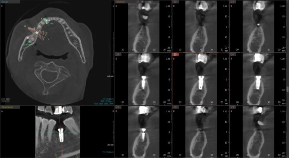 [임플란트] 이가 빠진지 오래되서 옆 치아들이 쓰러졌어요. 임플란트 가능할까요? 네, 가능합니다.1mm의 정교함으로! 관련 이미지 6