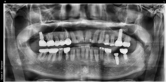 [임플란트] 재신경치료를 시도할 수 없을 때. 뼈이식 없는 임플란트 시술로 간편하게. 관련 이미지 8
