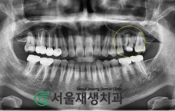 [재신경치료] 재신경치료까지 했는데 계속 아파요..미세 현미경을 이용한 세번째 신경치료! (서울재생치과) 관련 이미지 3
