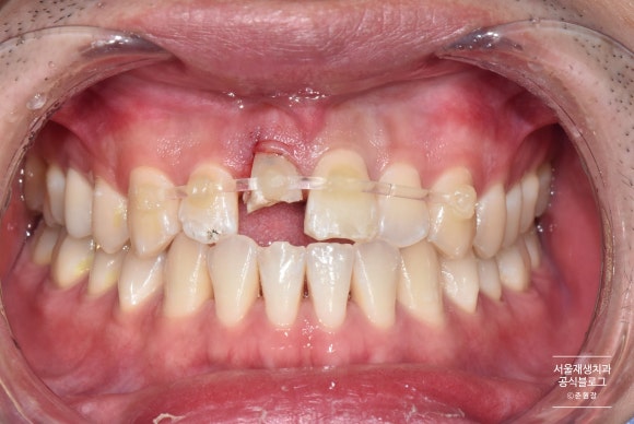 넘어져서 이가 여러군데 깨졌어요ㅠ (치아외상토탈케어, 서울재생치과, 치아 부러짐, 치아 파절) 관련 이미지 3