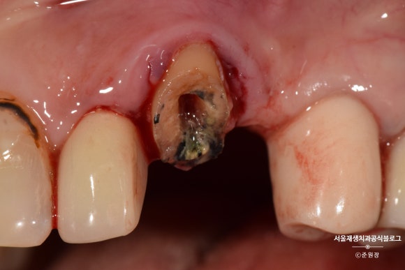 충치나 파절로 짧아진 치아도 다시 보자! (의도적 재식술/치아정출술 후 브릿지치료) 관련 이미지 5