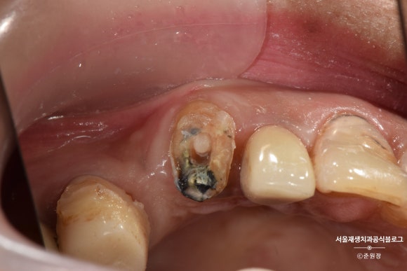 충치나 파절로 짧아진 치아도 다시 보자! (의도적 재식술/치아정출술 후 브릿지치료) 관련 이미지 9