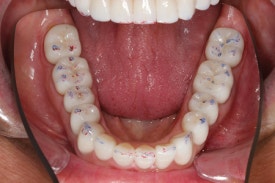 치과에서 치료하는 치아가 아닌 반대편 치아를 갈아내는 이유는? 장기 치료에 반드시 필요한 "정출방지 치아고정"에 대해 알아봅시다. 관련 이미지 7