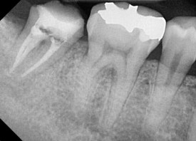 [재신경치료] 잇몸이 부었어요. 다니던 치과에서는 재신경치료 하거나 발치하라고 했어요. 관련 이미지 8