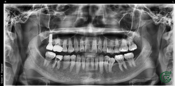 [재신경치료] 대학병원에서도 포기한 어금니...(재)재신경치료로 살려낸 이야기. (미세현미경Zeiss사용) 관련 이미지 2