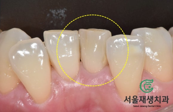[치아미백] 예전에 부딪힌 앞니가 까맣게 변했어요. 신경이 죽은 치아를 하얗게 돌려놓기! (서울재생치과) 관련 이미지 9