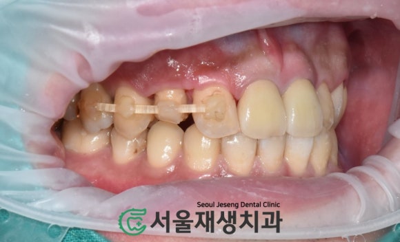 [치아정출술] 충치가 뿌리까지 진행되서 발치해야 한대요...뿌리 깊은 충치도 살려내기 (서울재생치과) 관련 이미지 10