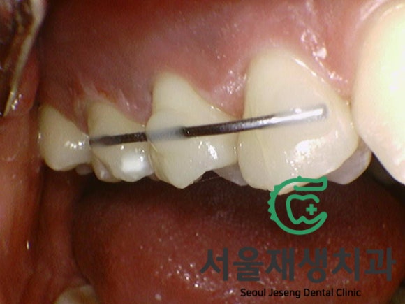 치과에서 치료하는 치아가 아닌 반대편 치아를 갈아내는 이유는? 장기 치료에 반드시 필요한 "정출방지 치아고정"에 대해 알아봅시다. 관련 이미지 10