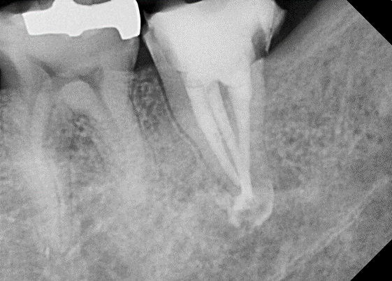 [신경치료] 아래 어금니를 신경치료 할 때 치료할 때 알아야 할 것 (C형근관,고난이도치료) 관련 이미지 10