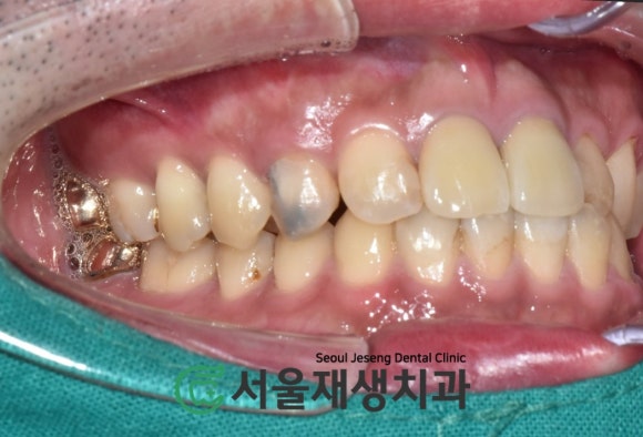 [치아정출술] 충치가 뿌리까지 진행되서 발치해야 한대요...뿌리 깊은 충치도 살려내기 (서울재생치과) 관련 이미지 5