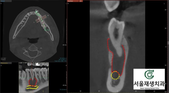 [치외치신경치료] 뿌리 끝 염증이 커서 발치해야된대요! 치아 머리에 볼~록! 알고보면 무서운 작은 혹 (서울재생치과) 관련 이미지 15