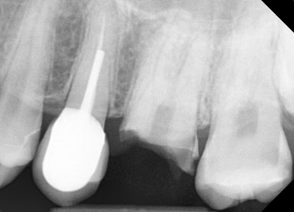 [치아살리기] 부러진 치아를 빼고 임플란트해야 한대요. 관련 이미지 3