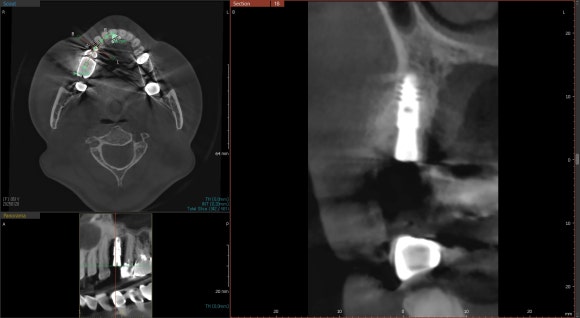 [임플란트] 좁은 공간에도 정밀하게, 1mm의 정교함을 잡은 임플란트 치료 관련 이미지 5