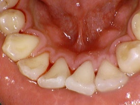 스케일링, 1년에 한 번만 보험이 되나요? 보험스케일링 수시로 받는 법 (건강보험적용 치과치료) 관련 이미지 5