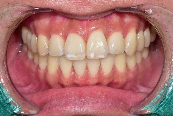 얼룩덜룩한 흰반점, white spot을 치료하는 법 (무삭제 충치치료) 관련 이미지 3