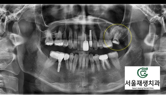 [재신경치료] 타치과에서 재신경치료 하는 중인데 발치를 하자고 했어요... (서울재생치과 현미경 신경치료) 관련 이미지 3