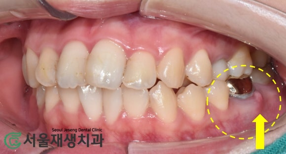 [재신경치료] 예전에 신경치료 받은 치아....치근단 절제술이나 발치를 해야 한다는데요?! (신촌 서울재생치과) 관련 이미지 6