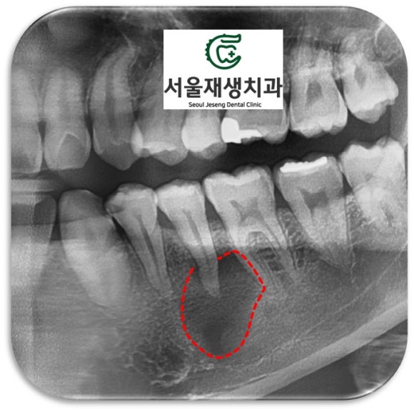 [치외치신경치료] 뿌리 끝 염증이 커서 발치해야된대요! 치아 머리에 볼~록! 알고보면 무서운 작은 혹 (서울재생치과) 관련 이미지 12