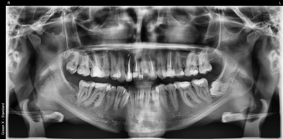 [재신경치료] 아래 어금니를 영국에서 신경치료 했는데, 아파져서 다시 치료 받고 싶어요. 관련 이미지 3