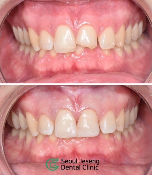 [치료사례] 전치부 레진수복 (크라운 없이 깨진 앞니 치료하는 법, 서울재생치과) 관련 이미지 1