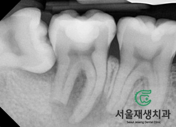 [고난이도 신경치료] 사랑니 때문에 뿌리가 흡수되어 버린 치아...살릴 수 있나요? 관련 이미지 3