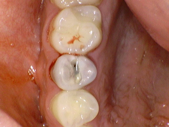 [치아살리기] 뿌리만 남은 치아의 치료 관련 이미지 5