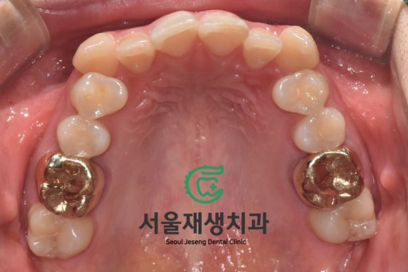[MTA충치치료] 충치가 클 때.. 신경치료 안하고 치료하는 법 (치수복조술, 신촌 서울재생치과) 관련 이미지 3