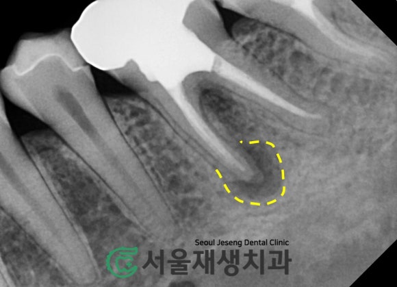 [재신경치료] 예전에 신경치료 받은 치아....치근단 절제술이나 발치를 해야 한다는데요?! (신촌 서울재생치과) 관련 이미지 5