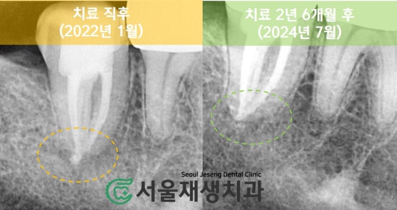 재신경치료 2년 후, 다시 찾아오신 반가운 얼굴^^ (서울재생치과 준원장) 관련 이미지 6