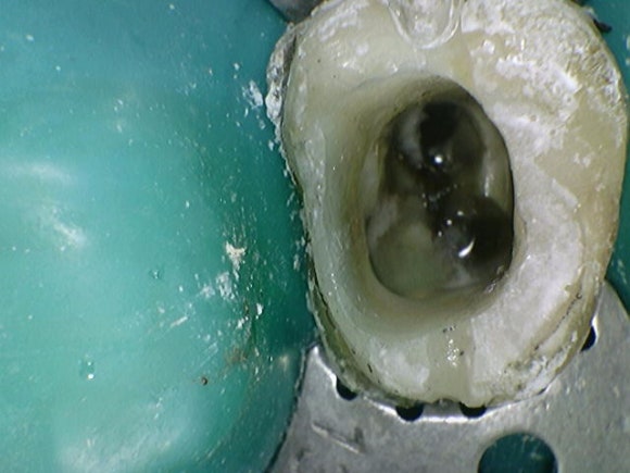 [재신경치료] 10년전에 한 신경치료가 뭔가 불편해요... 관련 이미지 5