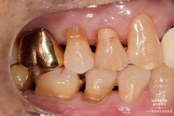 잇몸 패임, 무슨 재료로 때우나요? 레진과 글라스아이오노머(GI)로 치경부마모증 치료하기 (서울재생치과,신촌치과) 관련 이미지 21
