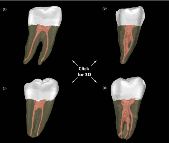 [신경치료] 아래 어금니를 신경치료 할 때 치료할 때 알아야 할 것 (C형근관,고난이도치료) 관련 이미지 6