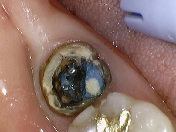 [재신경치료] 잇몸이 부었어요. 다니던 치과에서는 재신경치료 하거나 발치하라고 했어요. 관련 이미지 6