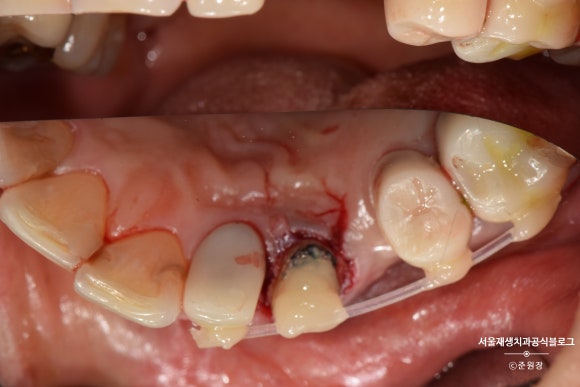 충치나 파절로 짧아진 치아도 다시 보자! (의도적 재식술/치아정출술 후 브릿지치료) 관련 이미지 8