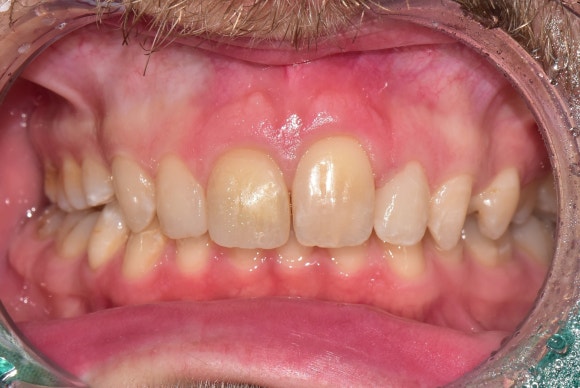 [앞니재치료] 얼룩덜룩한 오래된 레진, 새 이처럼 환하게 재치료하기 관련 이미지 4