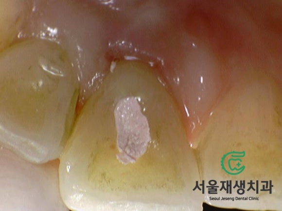 [치아미백] 예전에 다친 치아가 최근에 변색됐어요. 어떻게 해결하나요? (서울재생치과) 관련 이미지 5