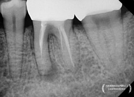 [재신경치료] 예전에 신경치료 받은 치아가 갑자기 붓고 아파요! (현미경을 통해 정확하고 섬세하게 재신경치료 하기) 관련 이미지 25