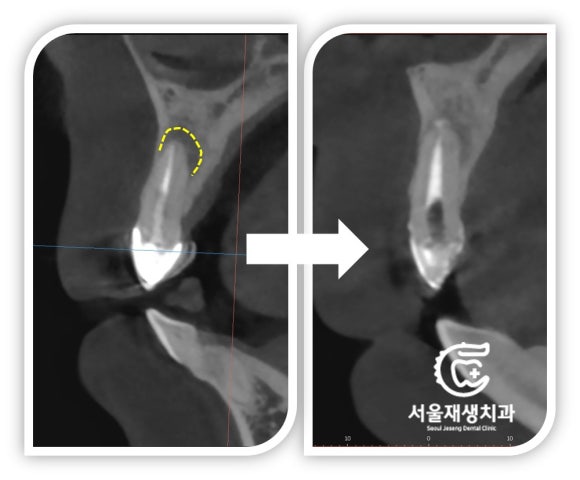 [재신경치료] 소중한 내 앞니...재신경치료로 다시 한 번 살려 쓸 수 있습니다. (서울재생치과, 현미경신경치료) 관련 이미지 12