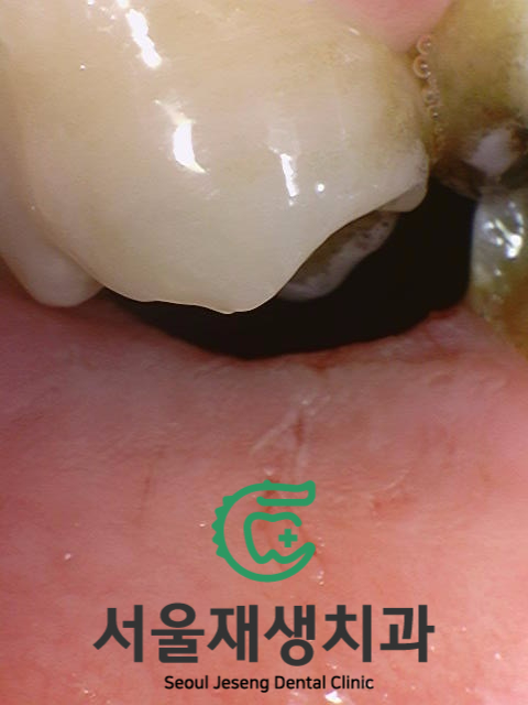 치과에서 치료하는 치아가 아닌 반대편 치아를 갈아내는 이유는? 장기 치료에 반드시 필요한 "정출방지 치아고정"에 대해 알아봅시다. 관련 이미지 9