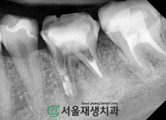 [재신경치료] 예전에 신경치료 받은 치아....치근단 절제술이나 발치를 해야 한다는데요?! (신촌 서울재생치과) 관련 이미지 11