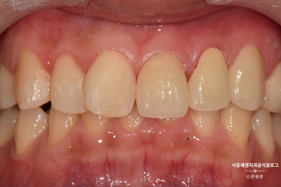 [치아외상] 부러진 앞니, 발치가 답인가요? (사고로 부러진 치아, 외과적정출술로 살리기) 관련 이미지 28