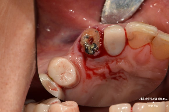 충치나 파절로 짧아진 치아도 다시 보자! (의도적 재식술/치아정출술 후 브릿지치료) 관련 이미지 15